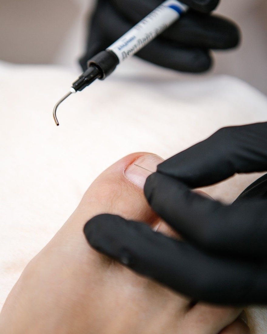 A titanium correction thread being applied to a toenail at Blanche Beauty